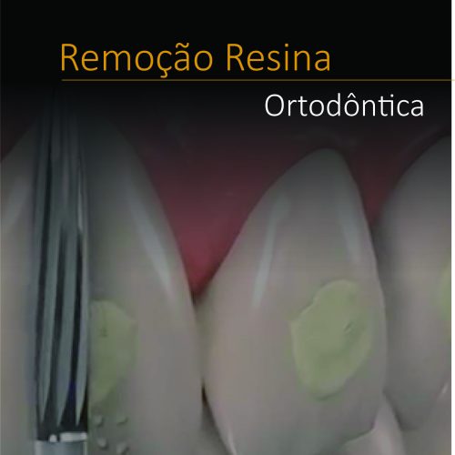 Remoção de Resina Ortodôntica